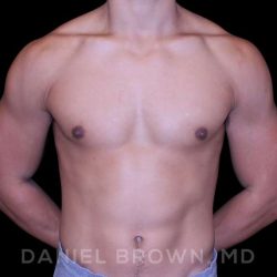 Gynecomastia Before & After Patient #10110