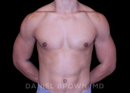 Gynecomastia Before & After Patient #10110