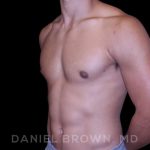 Gynecomastia Before & After Patient #10110