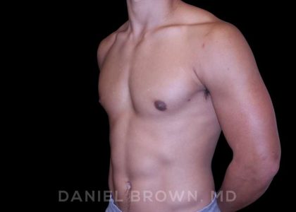 Gynecomastia Before & After Patient #10110