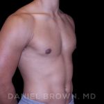 Gynecomastia Before & After Patient #10110