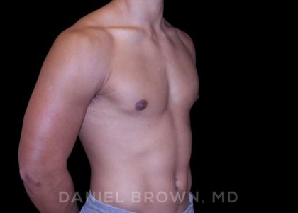Gynecomastia Before & After Patient #10110