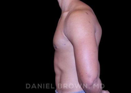 Gynecomastia Before & After Patient #10110