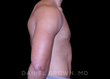 Gynecomastia Before & After Patient #10110