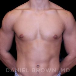 Gynecomastia Before & After Patient #10110