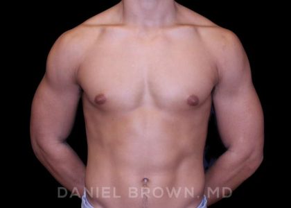 Gynecomastia Before & After Patient #10110
