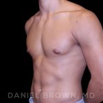 Gynecomastia Before & After Patient #10110