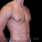 Gynecomastia Before & After Patient #10110