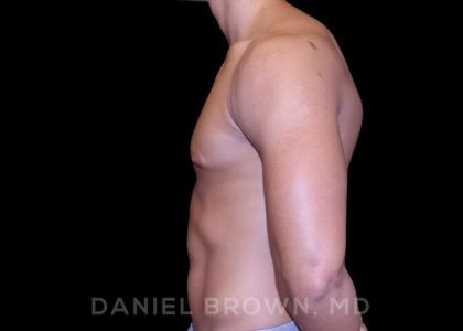 Gynecomastia Before & After Patient #10110
