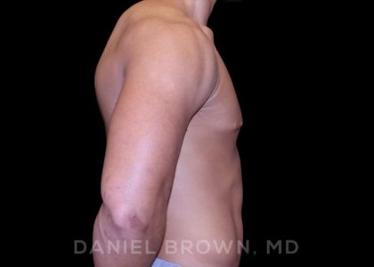 Gynecomastia Before & After Patient #10110