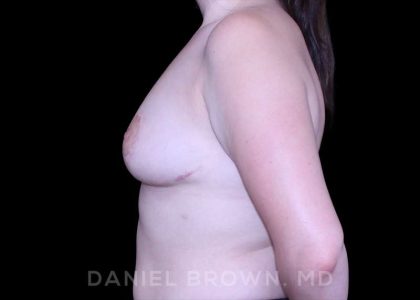 Bellesoma Breast Lift Before & After Patient #8441