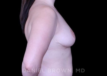 Bellesoma Breast Lift Before & After Patient #8441