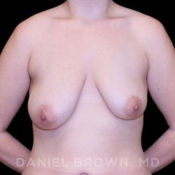 Bellesoma Breast Lift Before & After Patient #8441