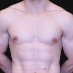 Gynecomastia Before & After Patient #10121