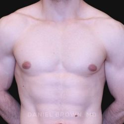 Gynecomastia Before & After Patient #10121