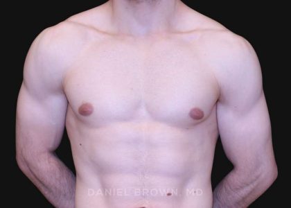 Gynecomastia Before & After Patient #10121