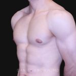 Gynecomastia Before & After Patient #10121