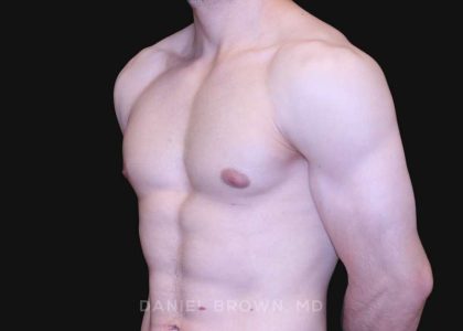 Gynecomastia Before & After Patient #10121