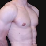 Gynecomastia Before & After Patient #10121