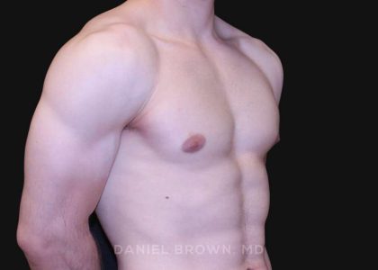 Gynecomastia Before & After Patient #10121