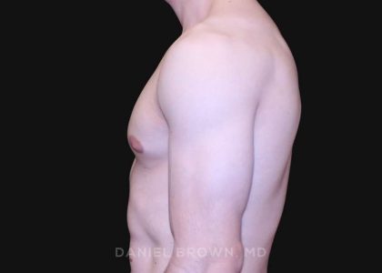 Gynecomastia Before & After Patient #10121