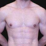 Gynecomastia Before & After Patient #10121