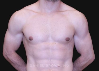 Gynecomastia Before & After Patient #10121