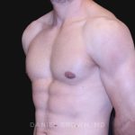 Gynecomastia Before & After Patient #10121