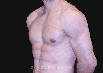 Gynecomastia Before & After Patient #10121