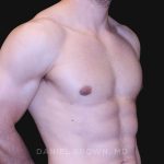 Gynecomastia Before & After Patient #10121