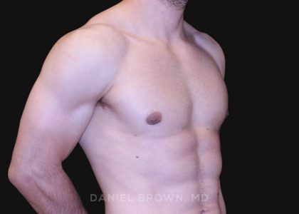 Gynecomastia Before & After Patient #10121