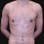 Gynecomastia Before & After Patient #10132