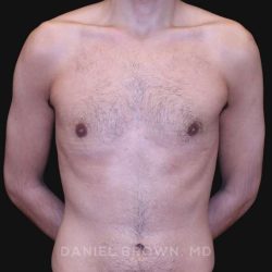 Gynecomastia Before & After Patient #10132