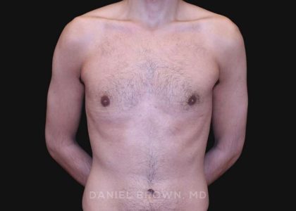 Gynecomastia Before & After Patient #10132