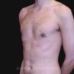 Gynecomastia Before & After Patient #10132