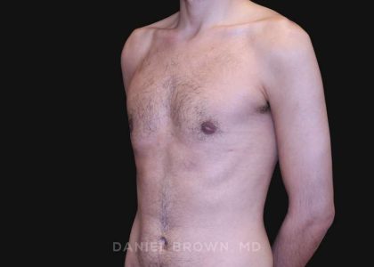 Gynecomastia Before & After Patient #10132