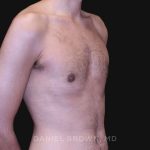 Gynecomastia Before & After Patient #10132
