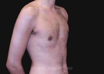 Gynecomastia Before & After Patient #10132