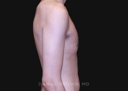 Gynecomastia Before & After Patient #10132