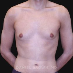 Gynecomastia Before & After Patient #10132