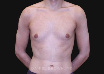 Gynecomastia Before & After Patient #10132