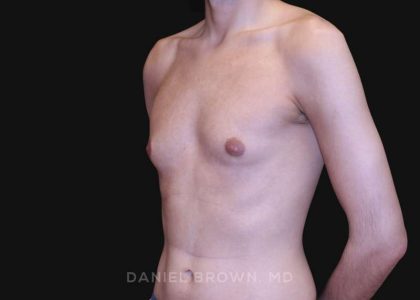 Gynecomastia Before & After Patient #10132