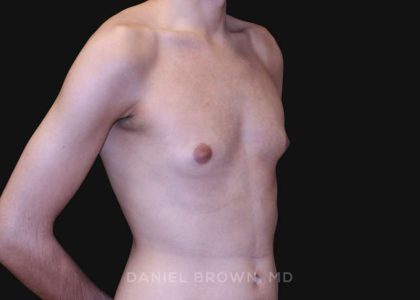Gynecomastia Before & After Patient #10132