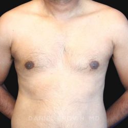 Gynecomastia Before & After Patient #10143