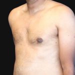Gynecomastia Before & After Patient #10143