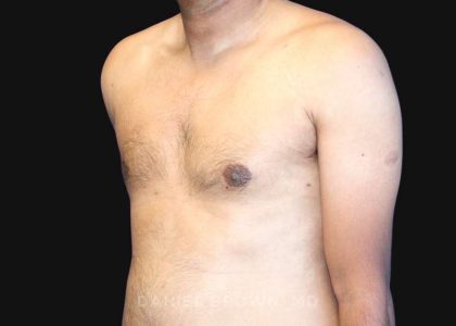 Gynecomastia Before & After Patient #10143