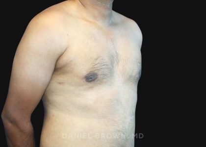 Gynecomastia Before & After Patient #10143