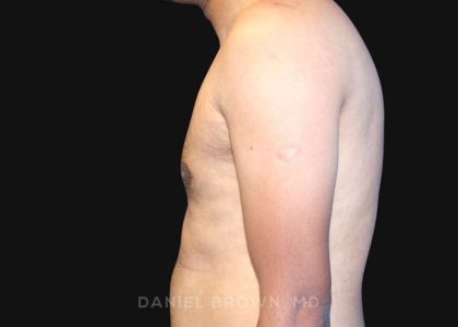 Gynecomastia Before & After Patient #10143