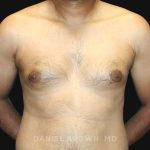 Gynecomastia Before & After Patient #10143