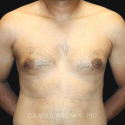 Gynecomastia Before & After Patient #10143